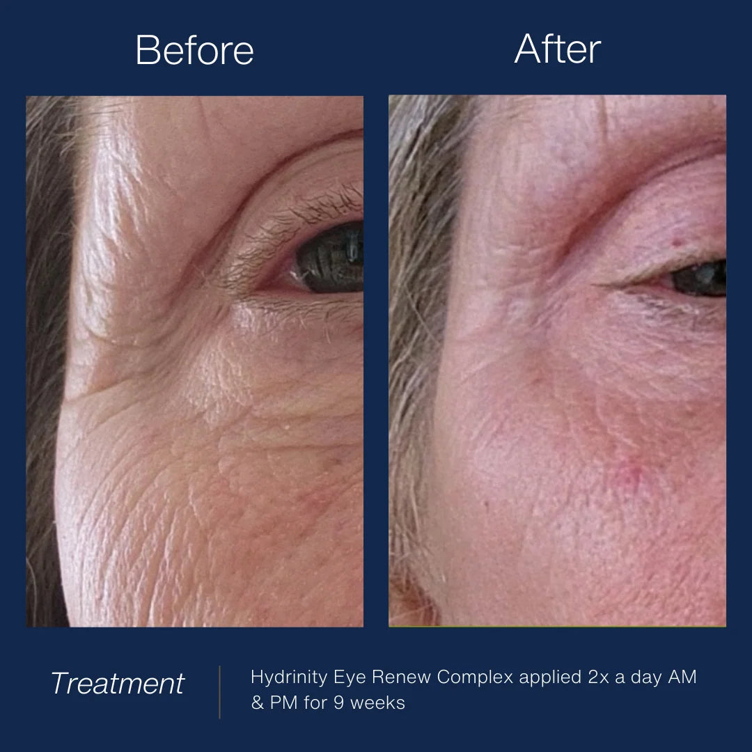 Hydrinity Eye Renew Complex.