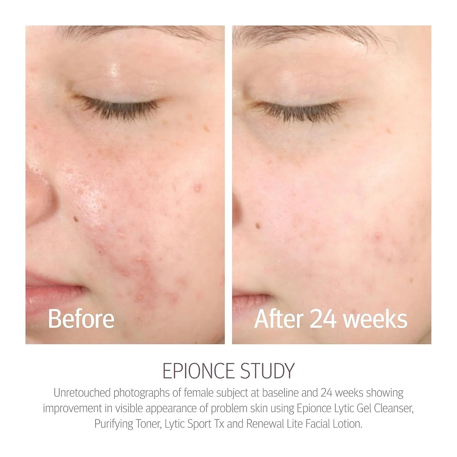 Epionce® Lytic Gel Cleanser