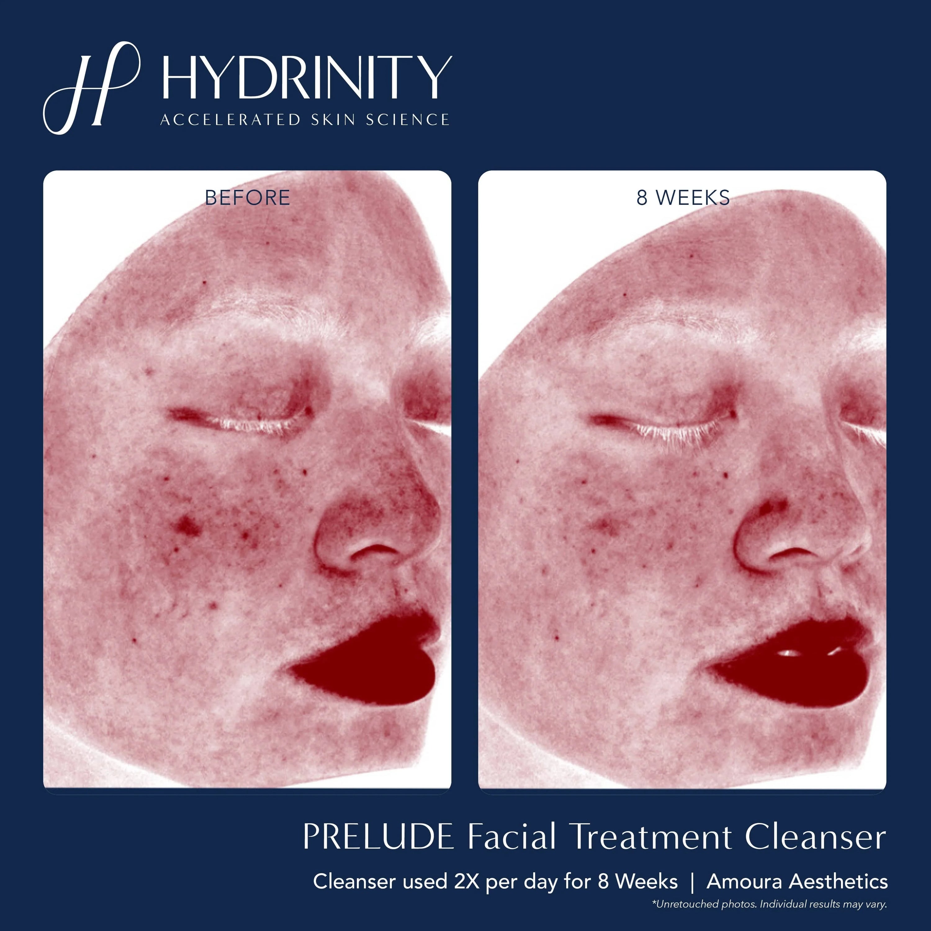 Hydrinity Prelude Facial Treatment Cleanser